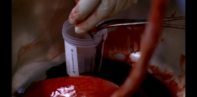 A clinician clumsily collecting cord blood in a plastic cup, with some spillage.