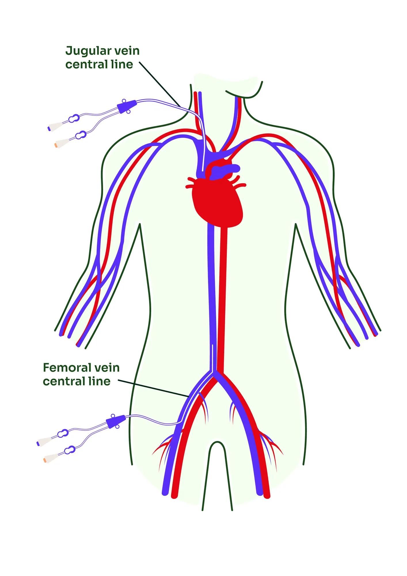 Central line insertion points diagram