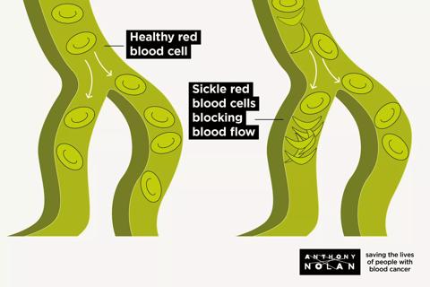 A diagram showing healthy red blood cells and sickle cells blocking the blood flow.