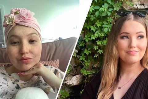 Stem Cell recipient, Sophie, before and after transaplant