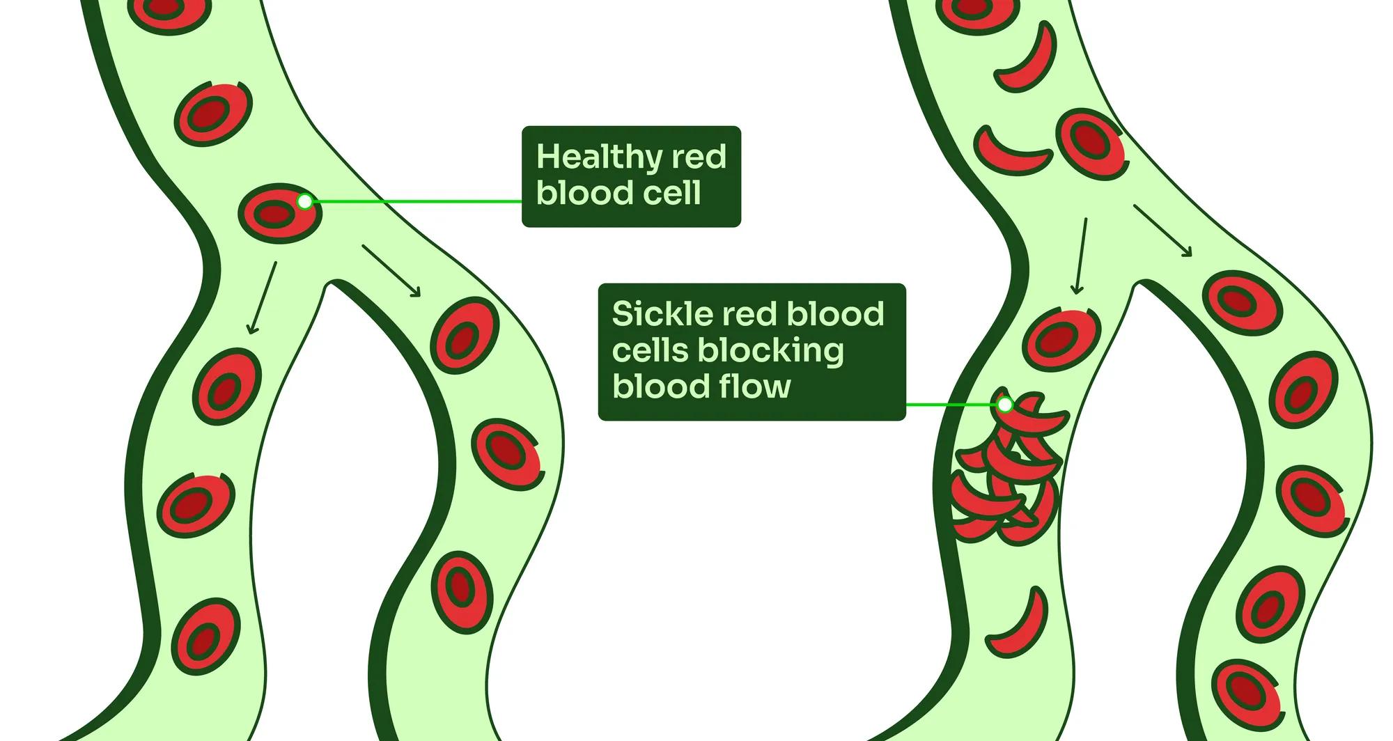 illustration of red blood cells in person with sickle cell disorder